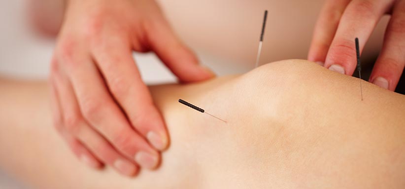 Acupuncture